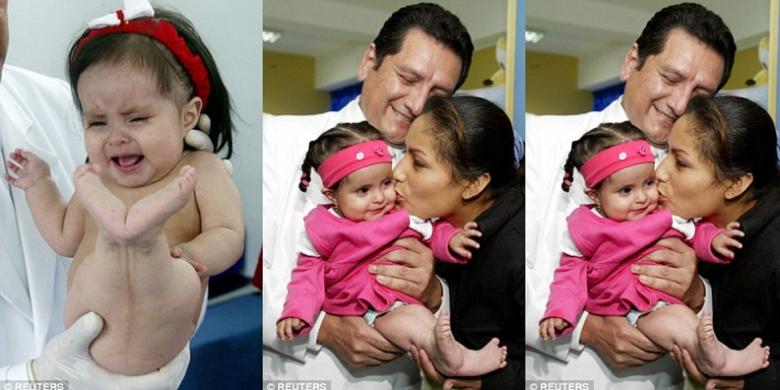 Bayi Ini Lahir dengan Tubuh Mirip Putri Duyung Bayi Ini Lahir dengan Tubuh Mirip Putri Duyung