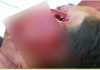 Telinga Warga Sungai Bati Sobek Tertancap Batu Kerikil