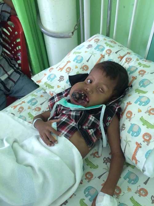 Aldi (3), seorang anak pengidap tumor gigi, warga Desa Sugi, Kecamatan Moro, Karimun.